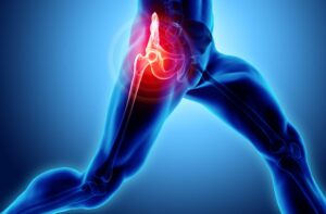Pain that might require anterior hip replacement surgery