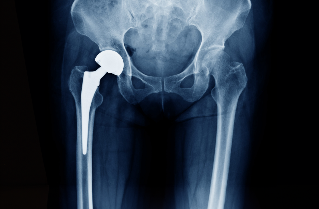 Total hip replacement surgery X-Ray of hip tool