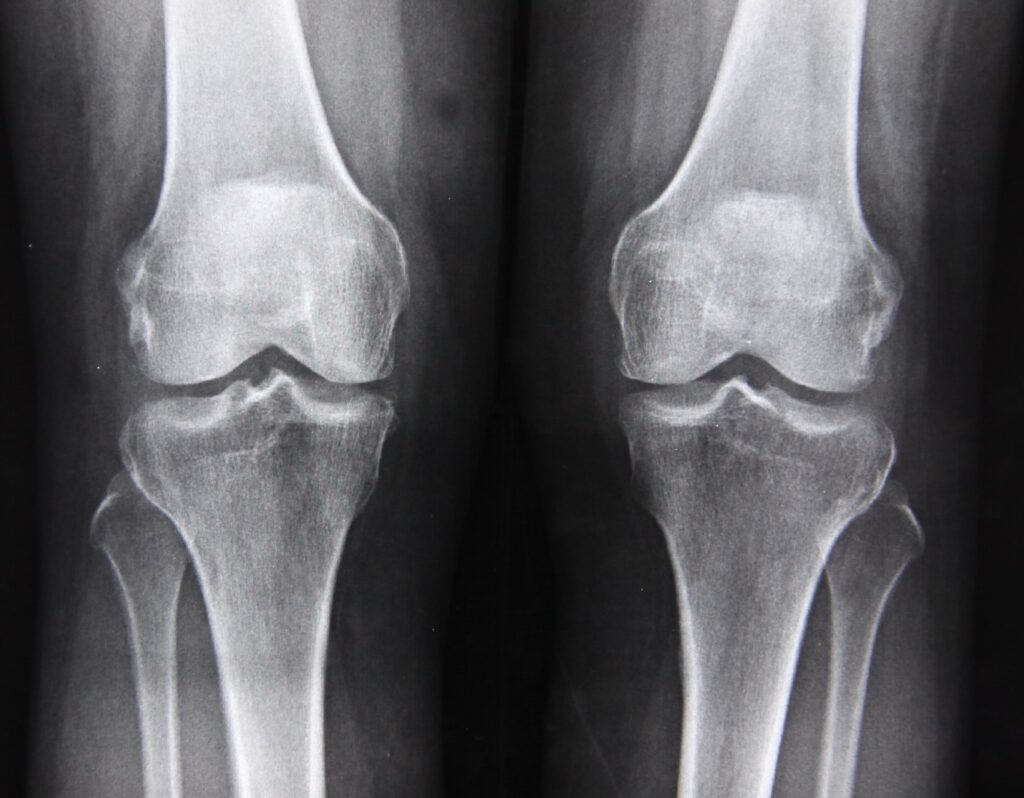 Knee X-ray's are performed during patient analysis, prepping for knee surgery.